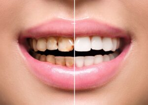 Teeth-scaling-dental-scaling-teeth-whitening