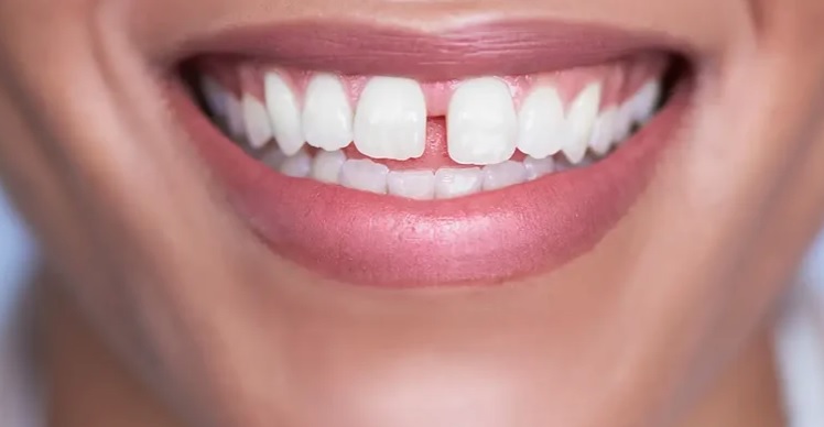 dental_diastema_closure_dhaka_bangladesh_teeth_gap_tooth_gap_composite_restoration