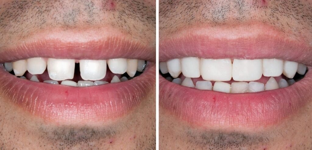 dental_diastema_closure_dhaka_bangladesh_teeth_gap_tooth_gap_composite_restoration_veneer_cosmetic