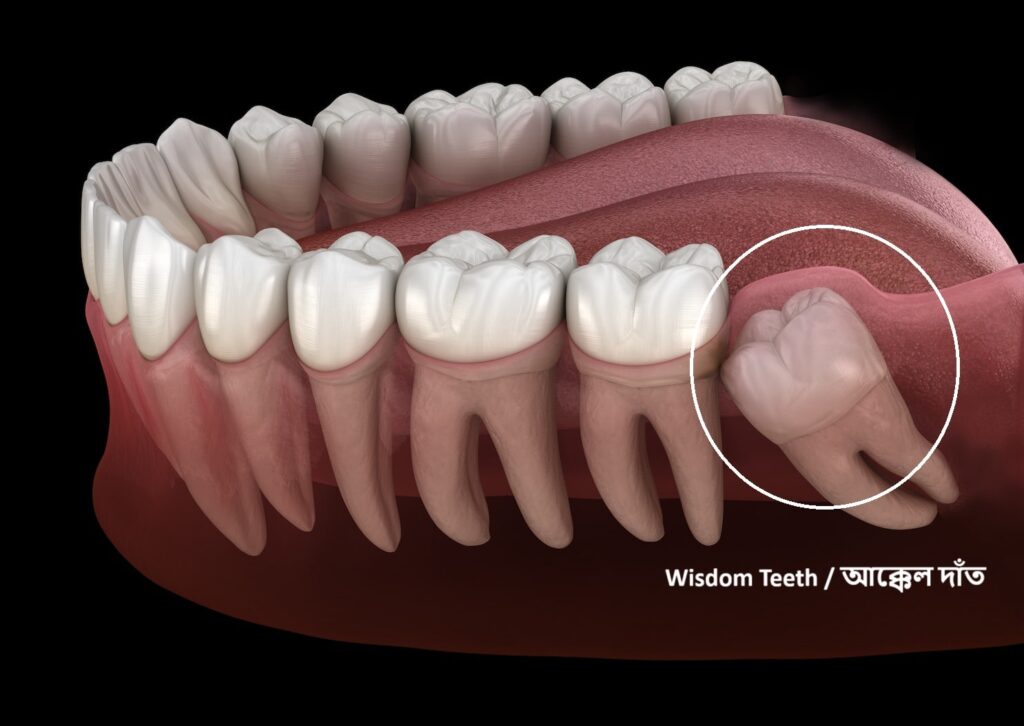 wisdom teeth আক্কেল দাত দাঁত