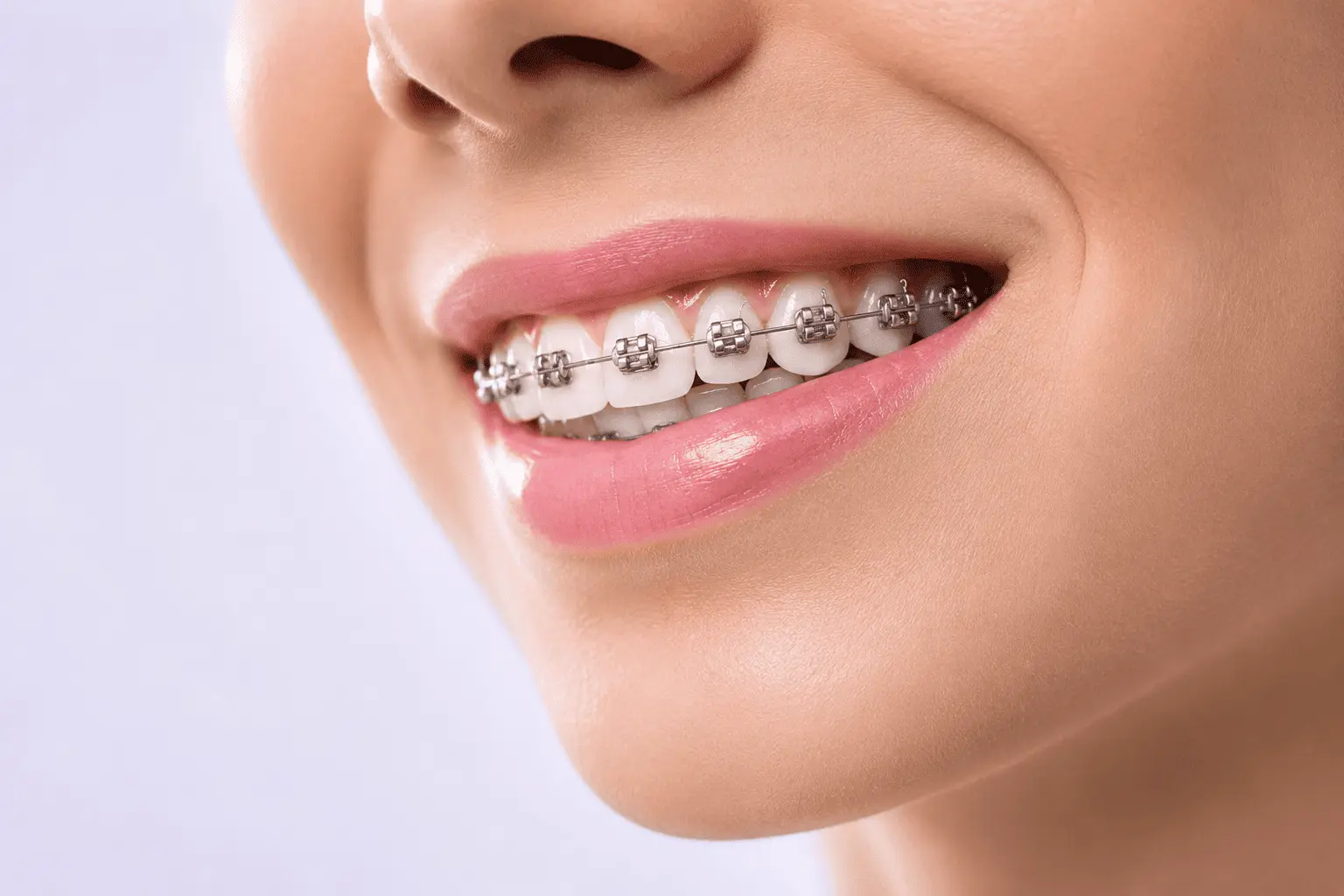 Braces Treatment in Mirpur, Dhaka at Sporsho Dental Care in 

Mirpur Dhaka