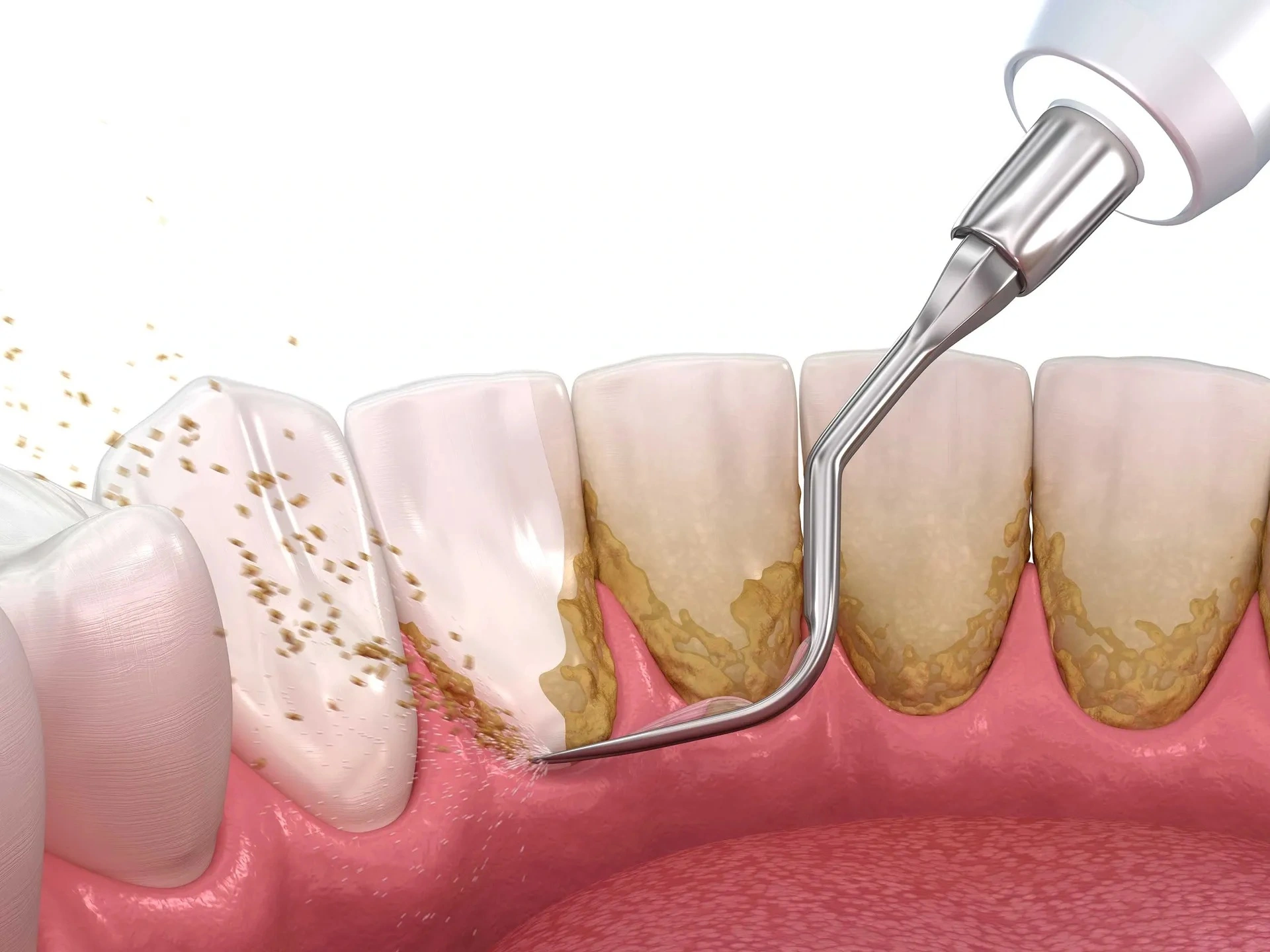 Dental Scaling treatment in Mirpur Dhaka at Sporsho Dental Care