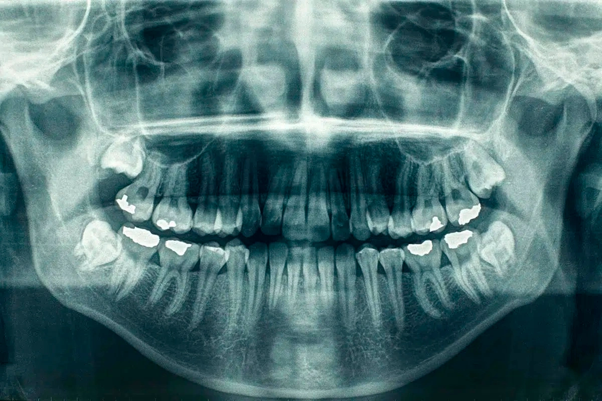 Dental X-Ray in Mirpur, Dhaka at Sporsho Dental Care in Mirpur Dhaka