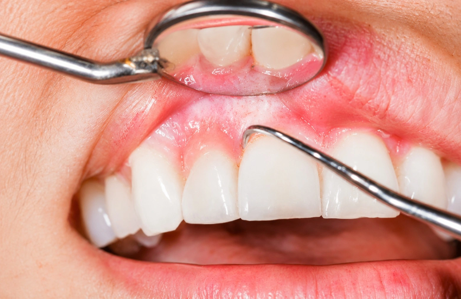 Gum Treatment treatment in Mirpur Dhaka at Sporsho Dental Care