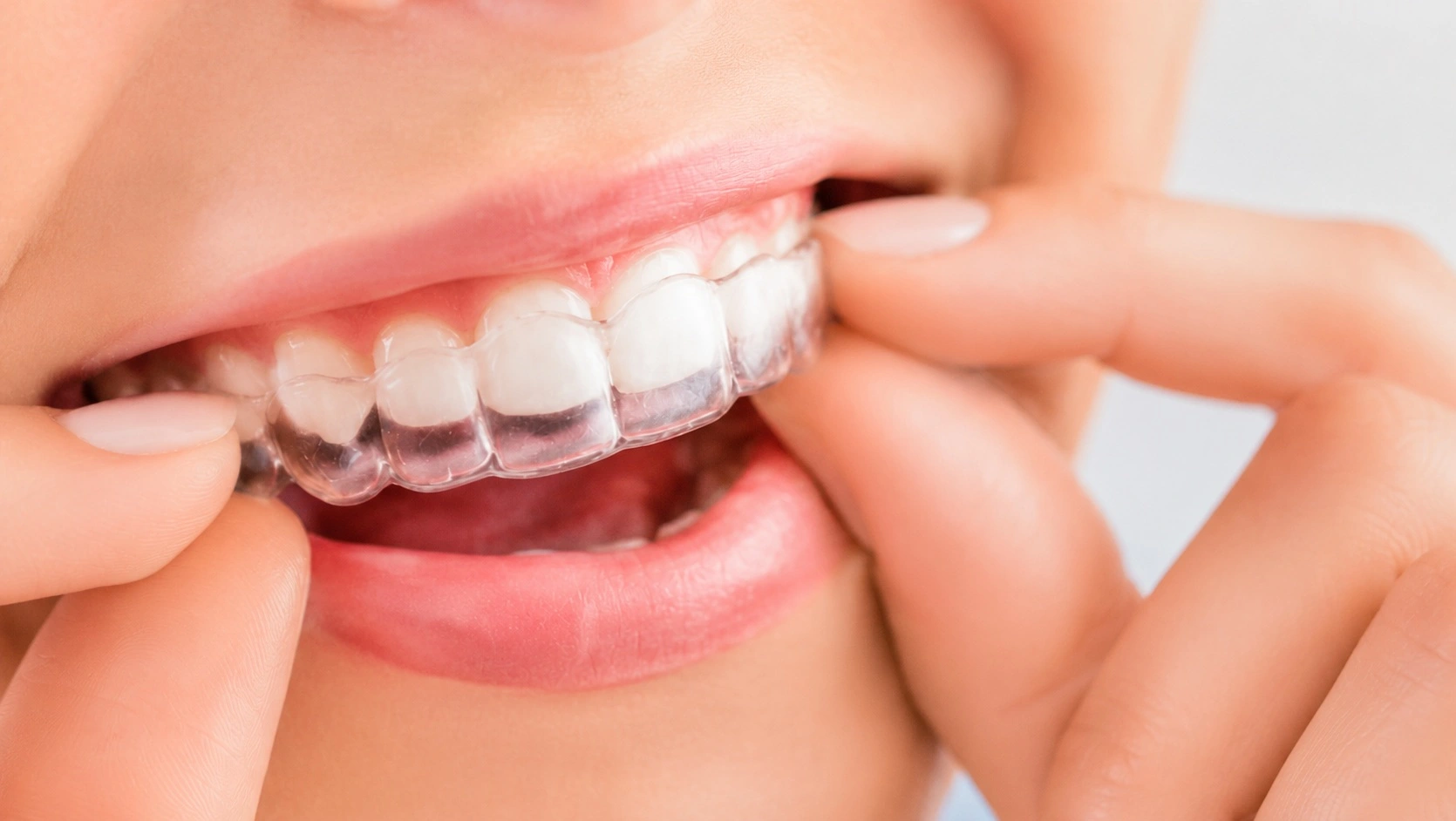 Night Guard treatment in Mirpur Dhaka at Sporsho Dental Care