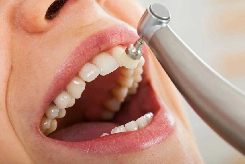Teeth polishing treatment in Mirpur Dhaka at Sporsho Dental Care