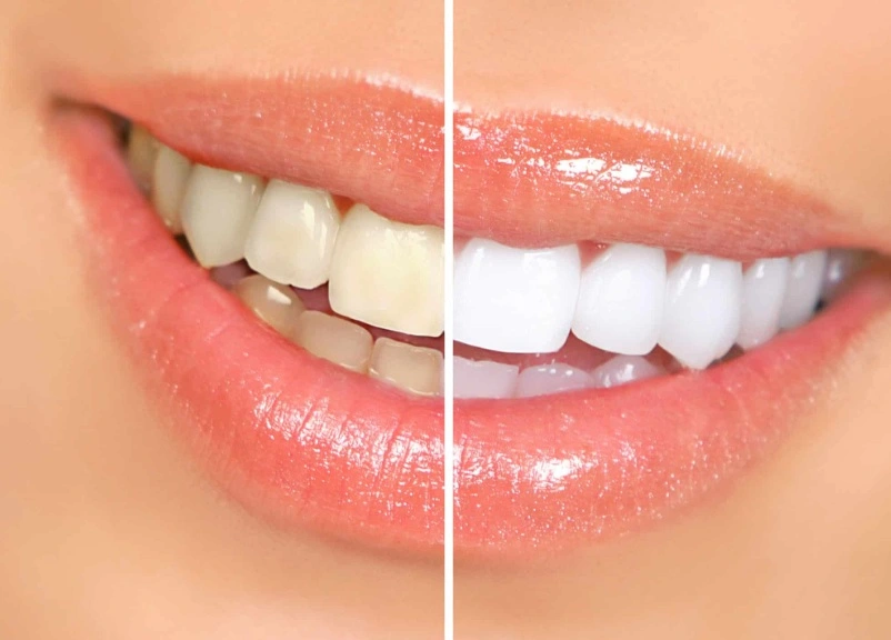 Teeth Whitening treatment in Mirpur Dhaka at Sporsho Dental Care
