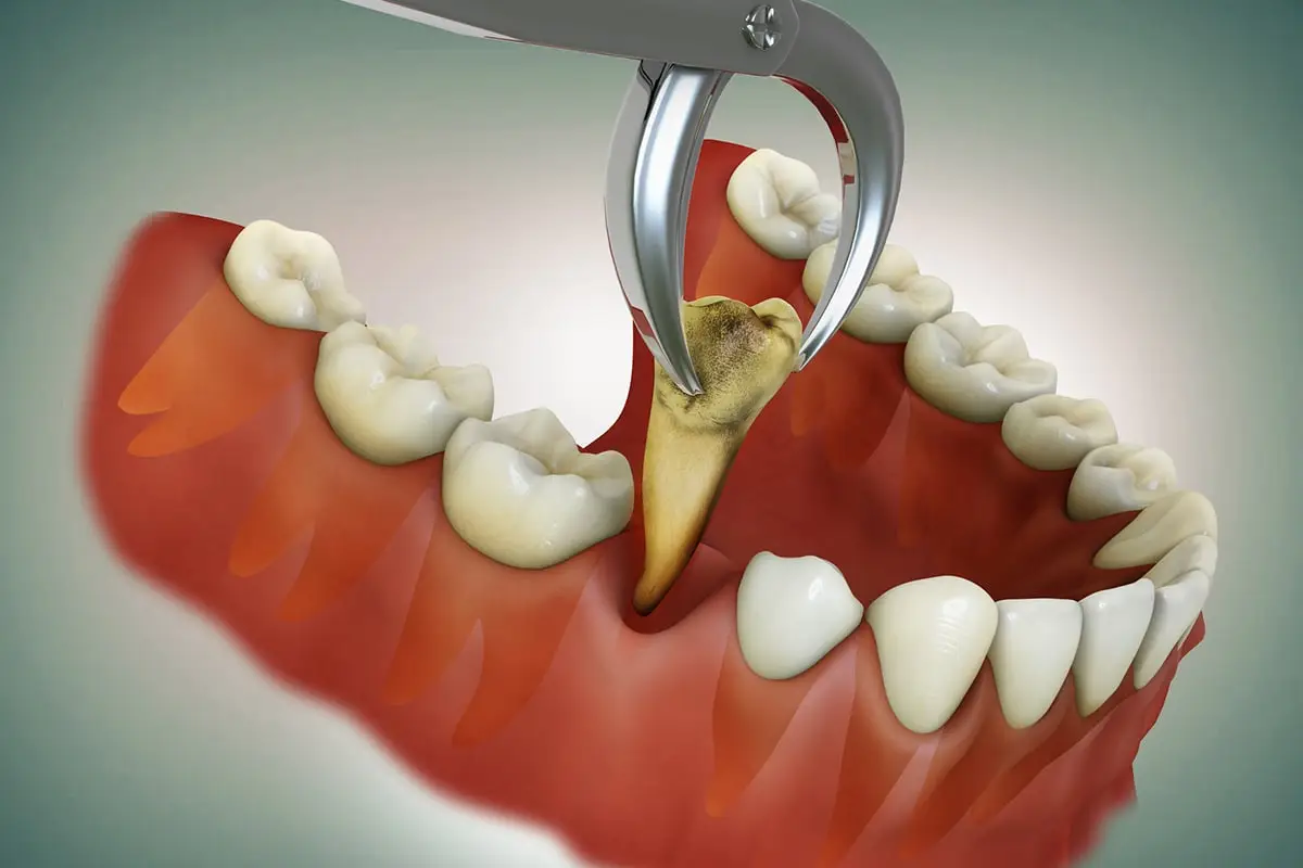 Tooth Extraction treatment in Mirpur Dhaka at Sporsho Dental Care